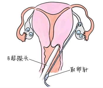 小儿退烧推拿手法 5种东莞捐卵宝宝退烧按摩方法